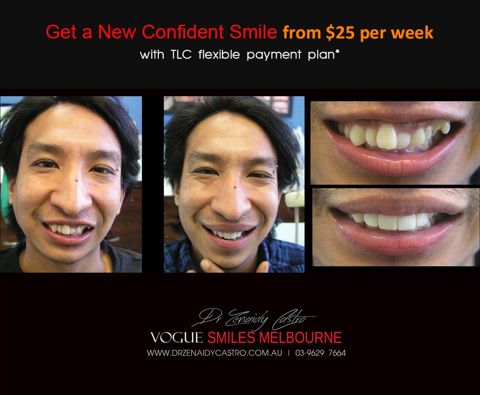 Composite Bonding resin veneers Melbourne CBD- Cosmetic Dentist Melbourne