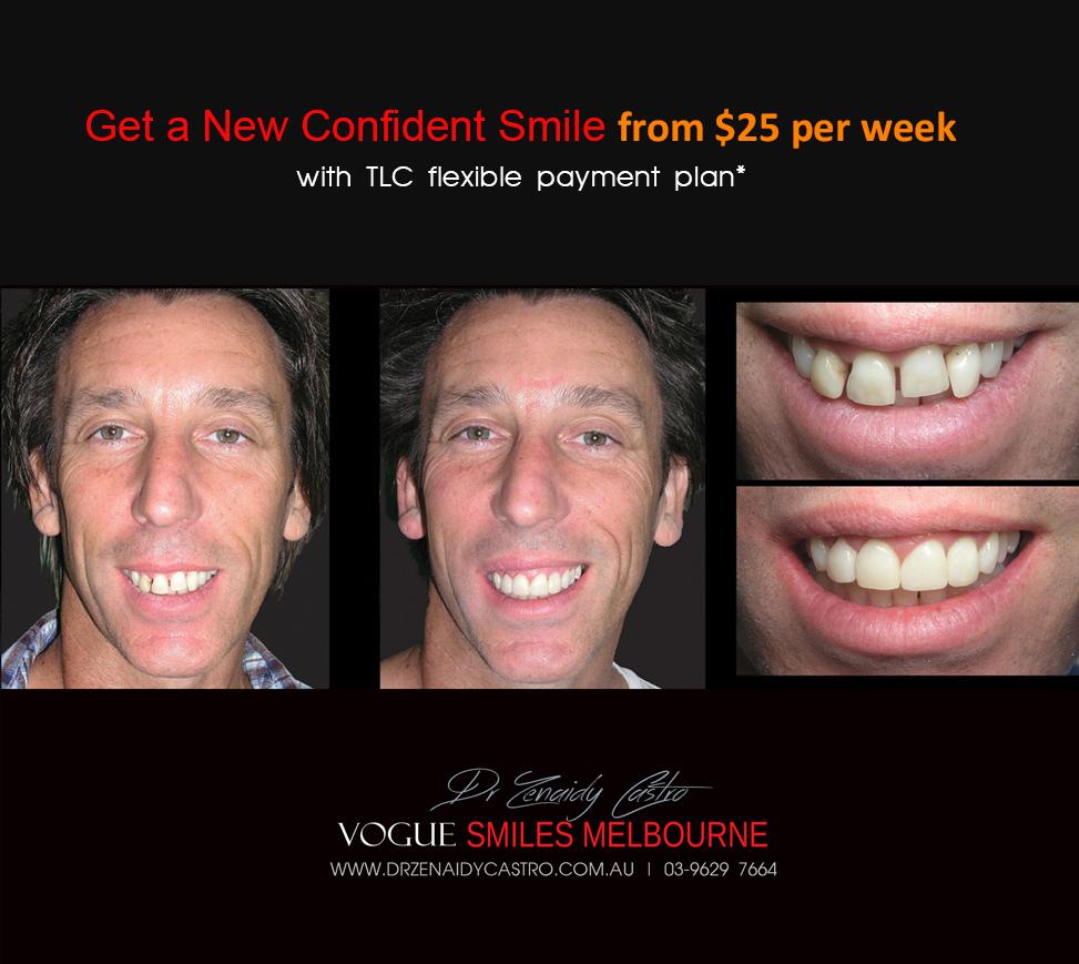 HOW MUCH DOES THE Cosmetic Dental Bonding or Composite Veneers COST IN MELBOURNE, Cost of Cosmetic Dental Bonding or Composite Veneers in Melbourne CBD?