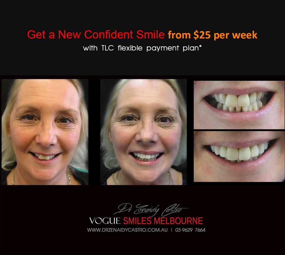 HOW MUCH DOES THE Cosmetic Dental Bonding or Composite Veneers COST IN MELBOURNE, Cost of Cosmetic Dental Bonding or Composite Veneers in Melbourne CBD?