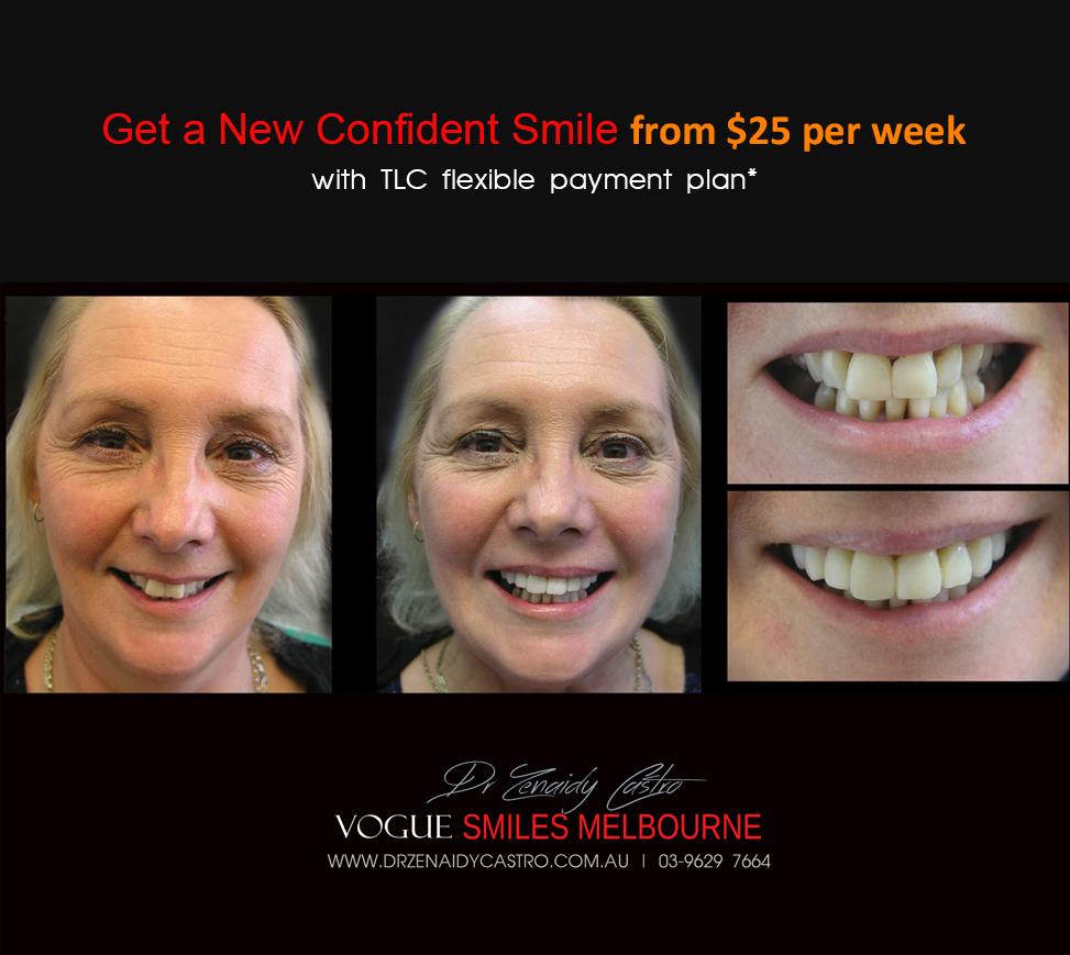 Composite Bonding resin veneers Melbourne CBD- Cosmetic Dentist Melbourne