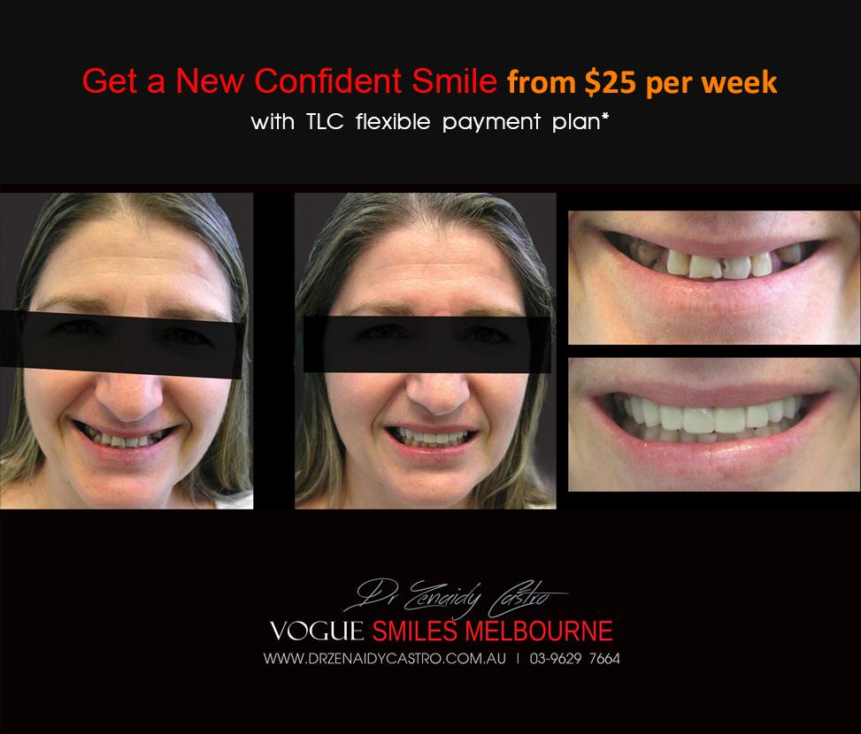 TRANSITIONAL SMILE MAKEOVER Melbourne CBD, Intermediate Cheapest most affordable Cosmetic Dentistry option to improve smile Melbourne Victoria Australia 