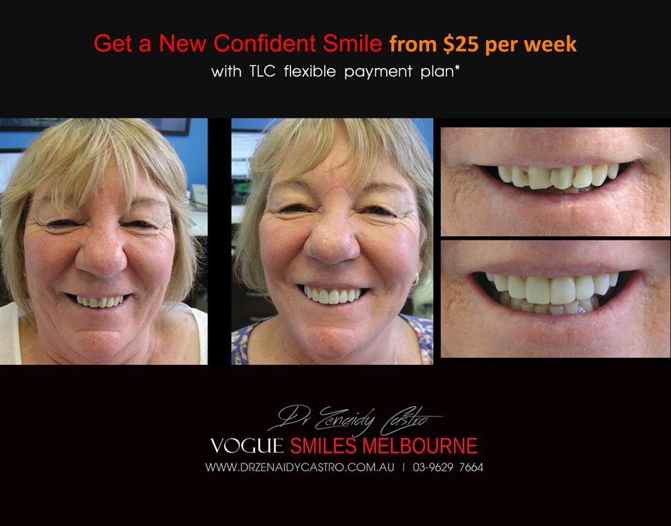 Composite Veneers Melbourne CBD, Composite Resin Bonding Melbourne CBD, Composite Bonding, Same day smile Melbourne CBD