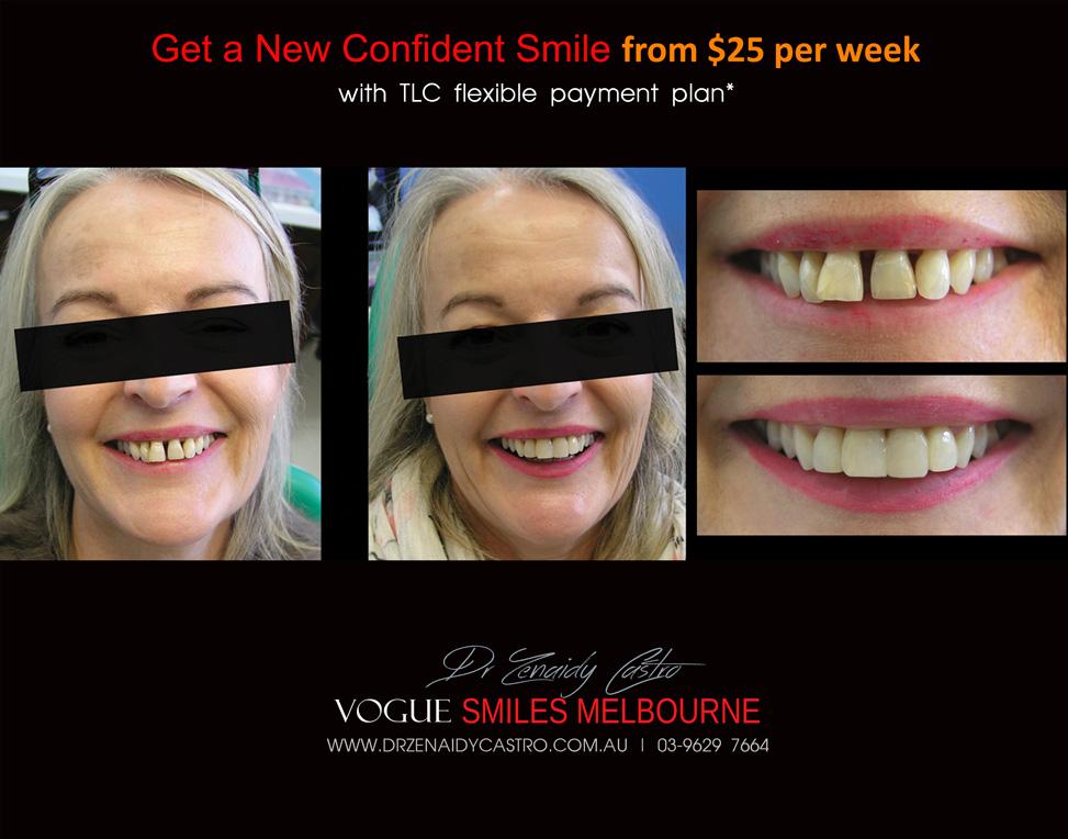 Composite Bonding resin veneers Melbourne CBD- Cosmetic Dentist Melbourne