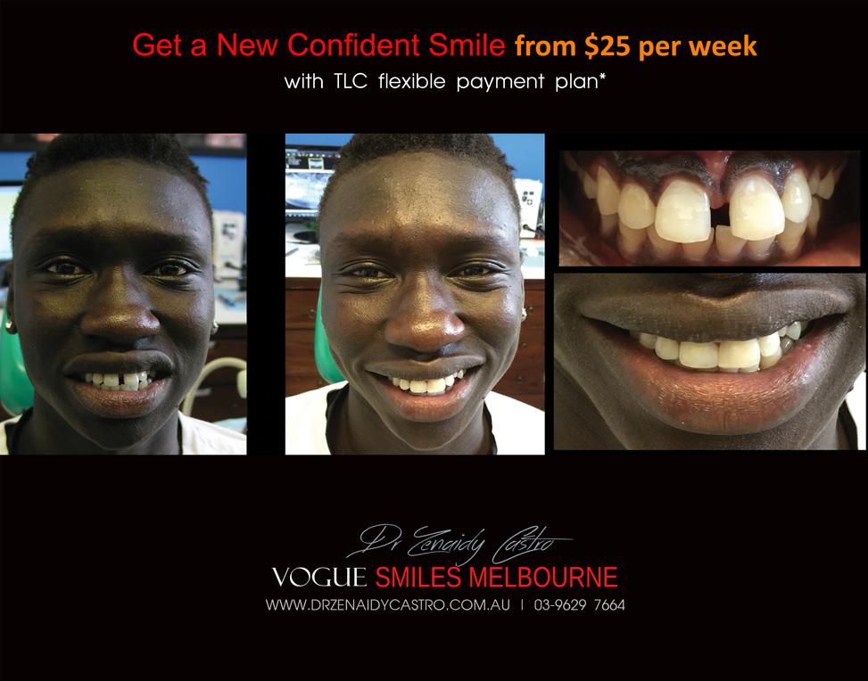 Composite Bonding resin veneers Melbourne CBD- Cosmetic Dentist Melbourne