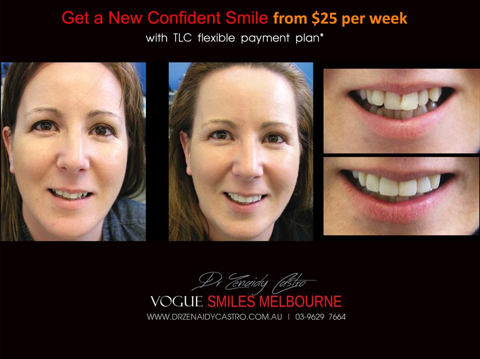 Dental Bonding Melbourne CBD, Composite Resin Bonding Melbourne City CBD , Composite Veneers Melbourne CBD -Composite Dental Bonding - Affordable Smile Makeover Procedure Affordable Cosmetic Dentist Melbourne CBD