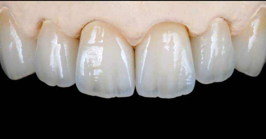 Dental Bonding. Cosmetic Dental Bonding, Composite Veneers versus PORCELAIN VENEERS Melbourne - Best Cosmetic Dentist 