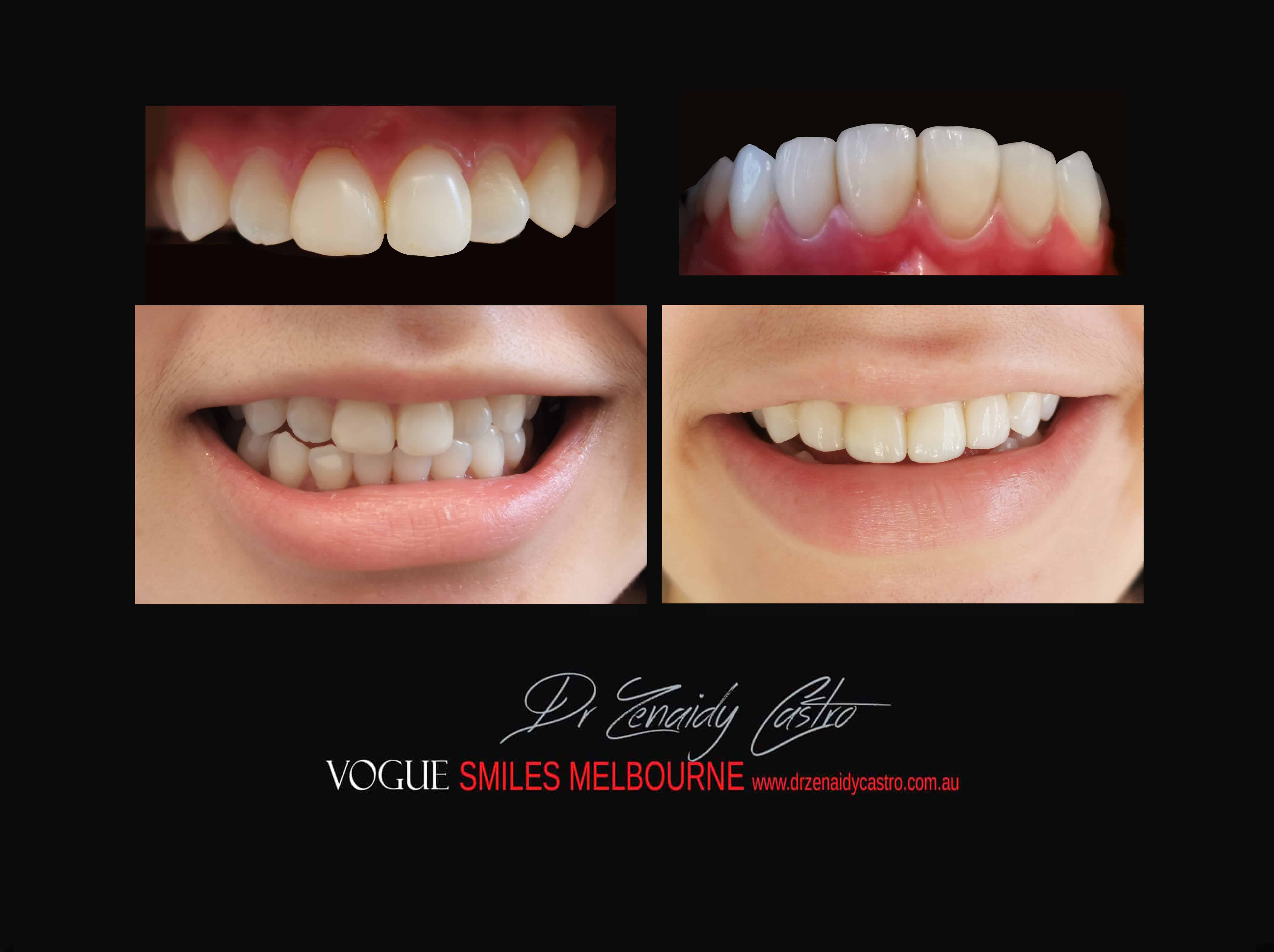 White Spots on Teeth and Enamel Defect Treatment Melbourne, Remove Tooth Discolouration Melbourne, Hypoplastic Teeth Melbourne CBD Victoria Australia