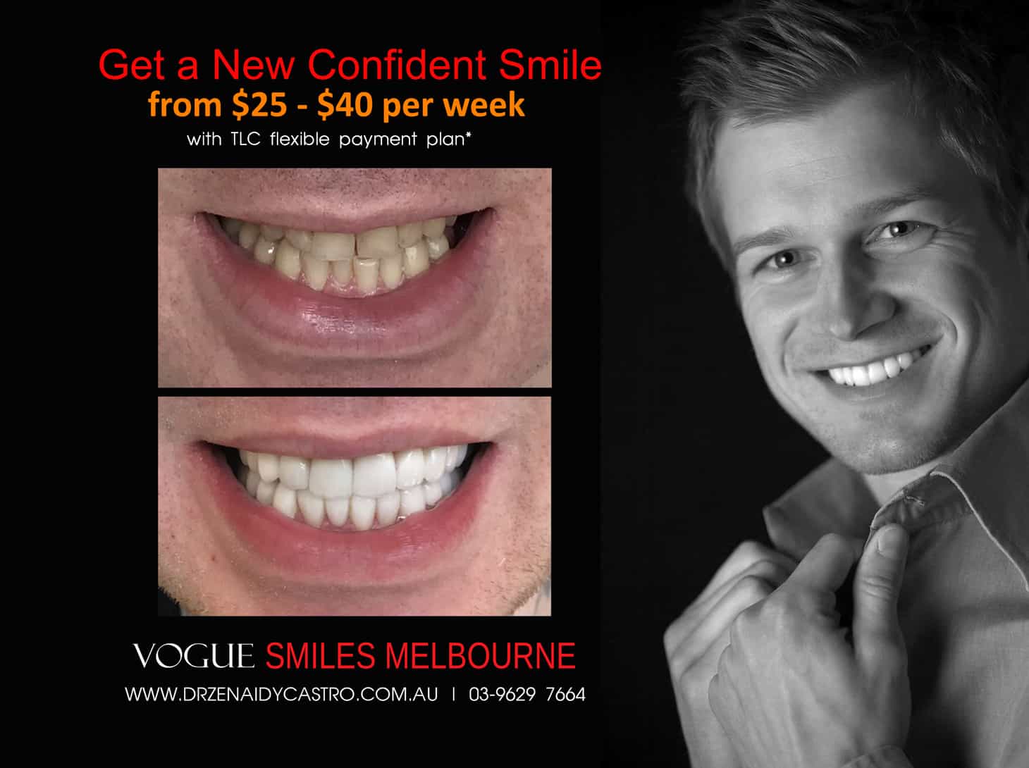 Permanent Teeth Whitening Treatment With Porcelain Veneers- MELBOURNE CBD COSMETIC DENTIST 