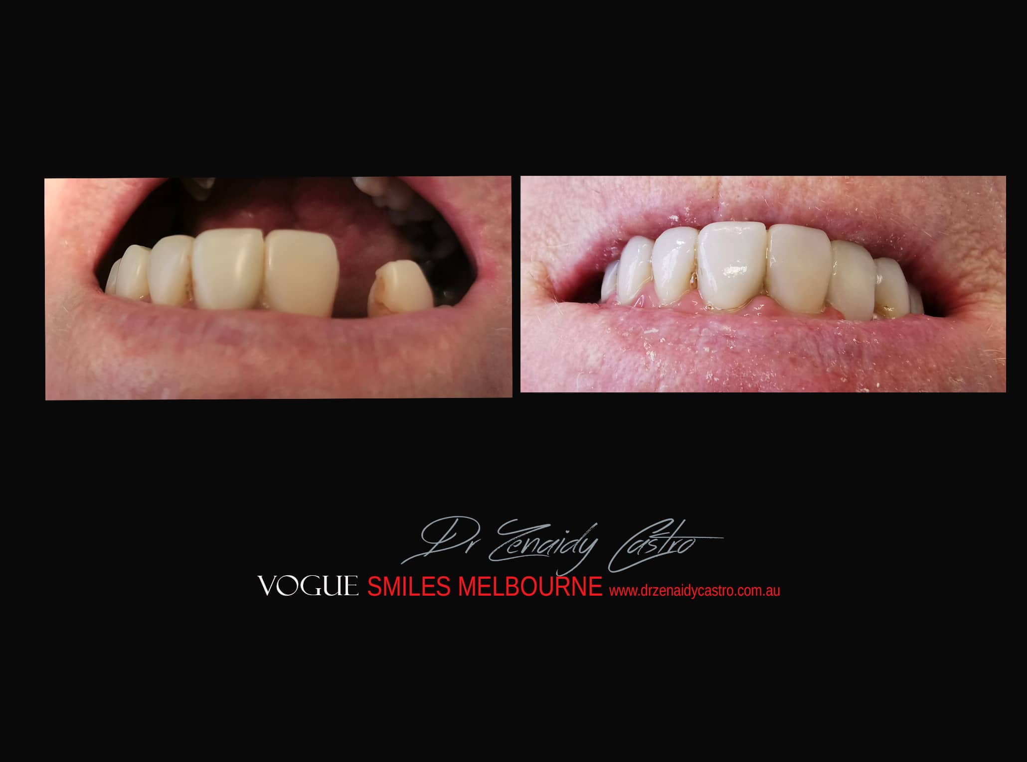 cheap, affordable, Low Cost Transitional Smile Makeover option Melbourne CBD