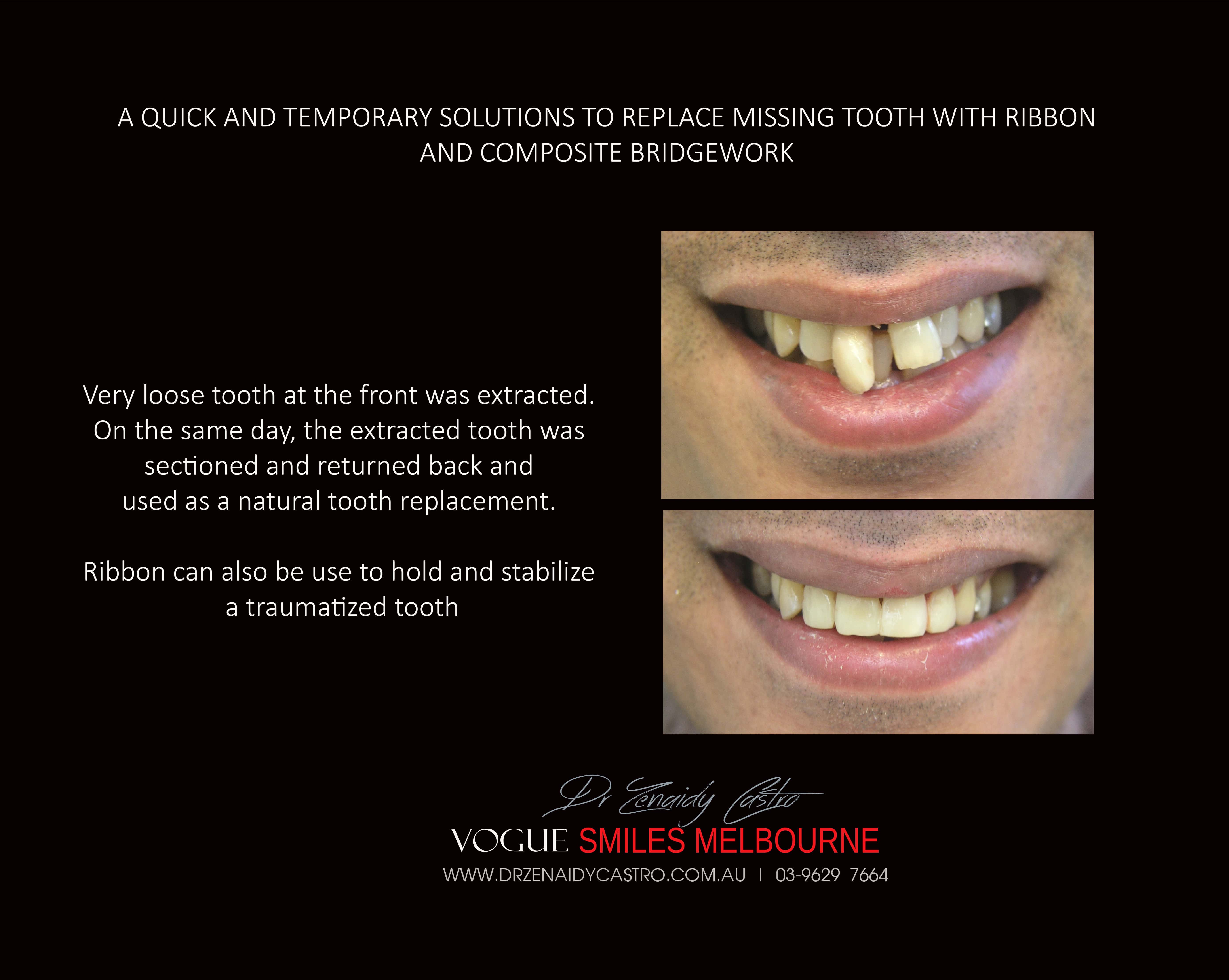 Replace Teeth Instantly - Affordable Same Day Smile Solution Melbourne -Intermediate smile Makeover Solution