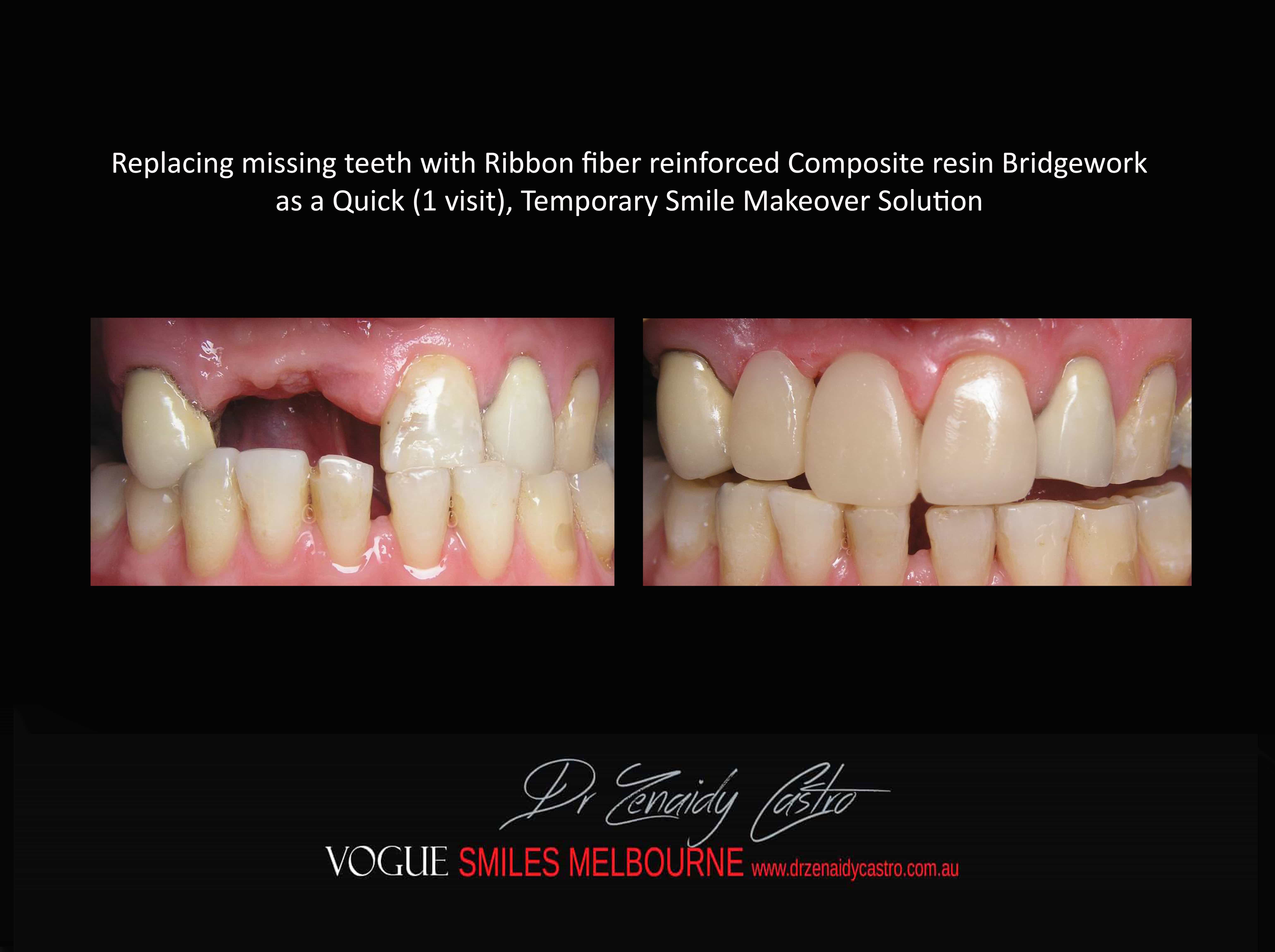 Replace Teeth Instantly - Affordable Same Day Smile Solution Melbourne -Intermediate smile Makeover Solution