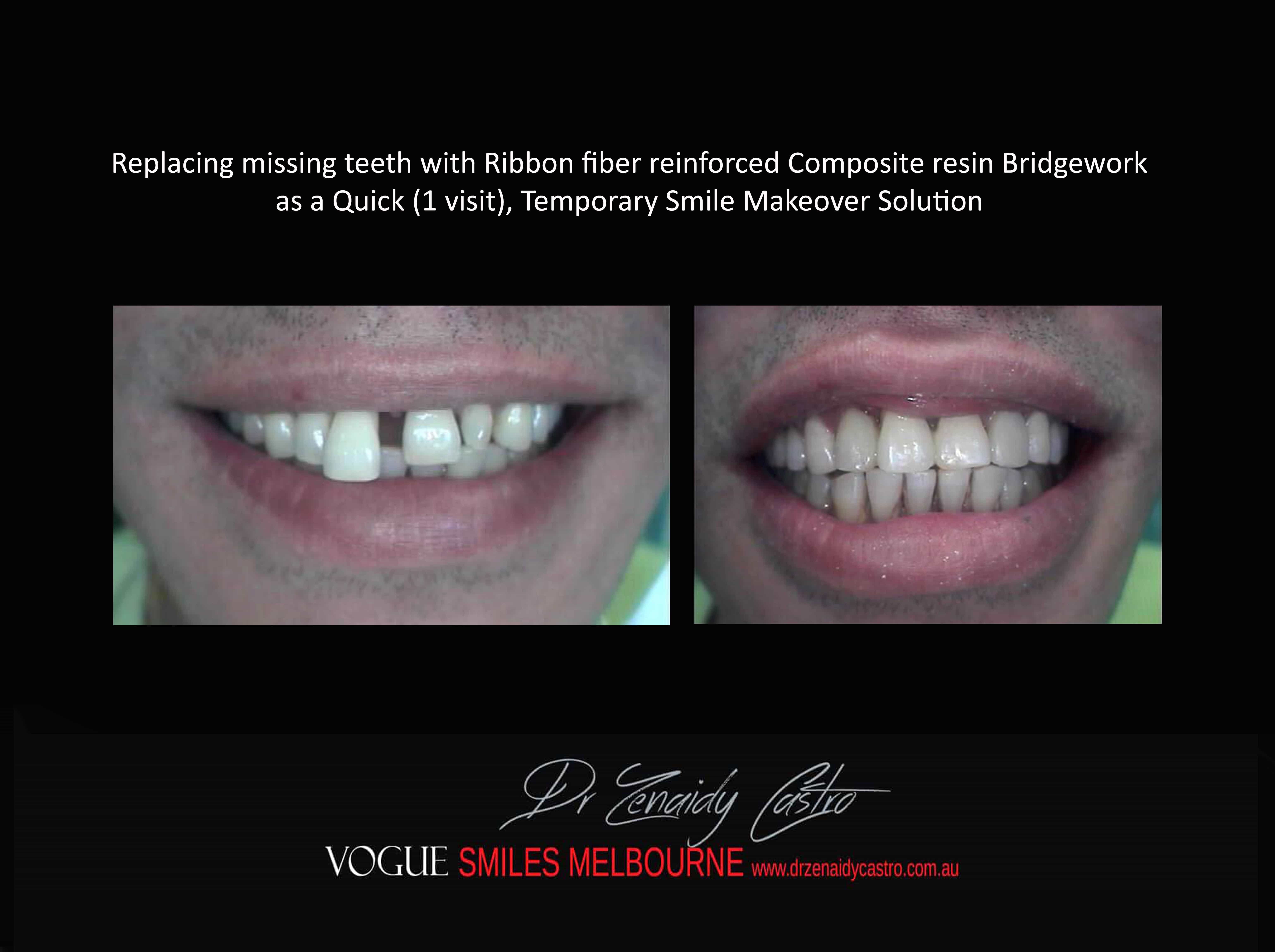 Replace Teeth Instantly - Affordable Same Day Smile Solution Melbourne -Intermediate smile Makeover Solution