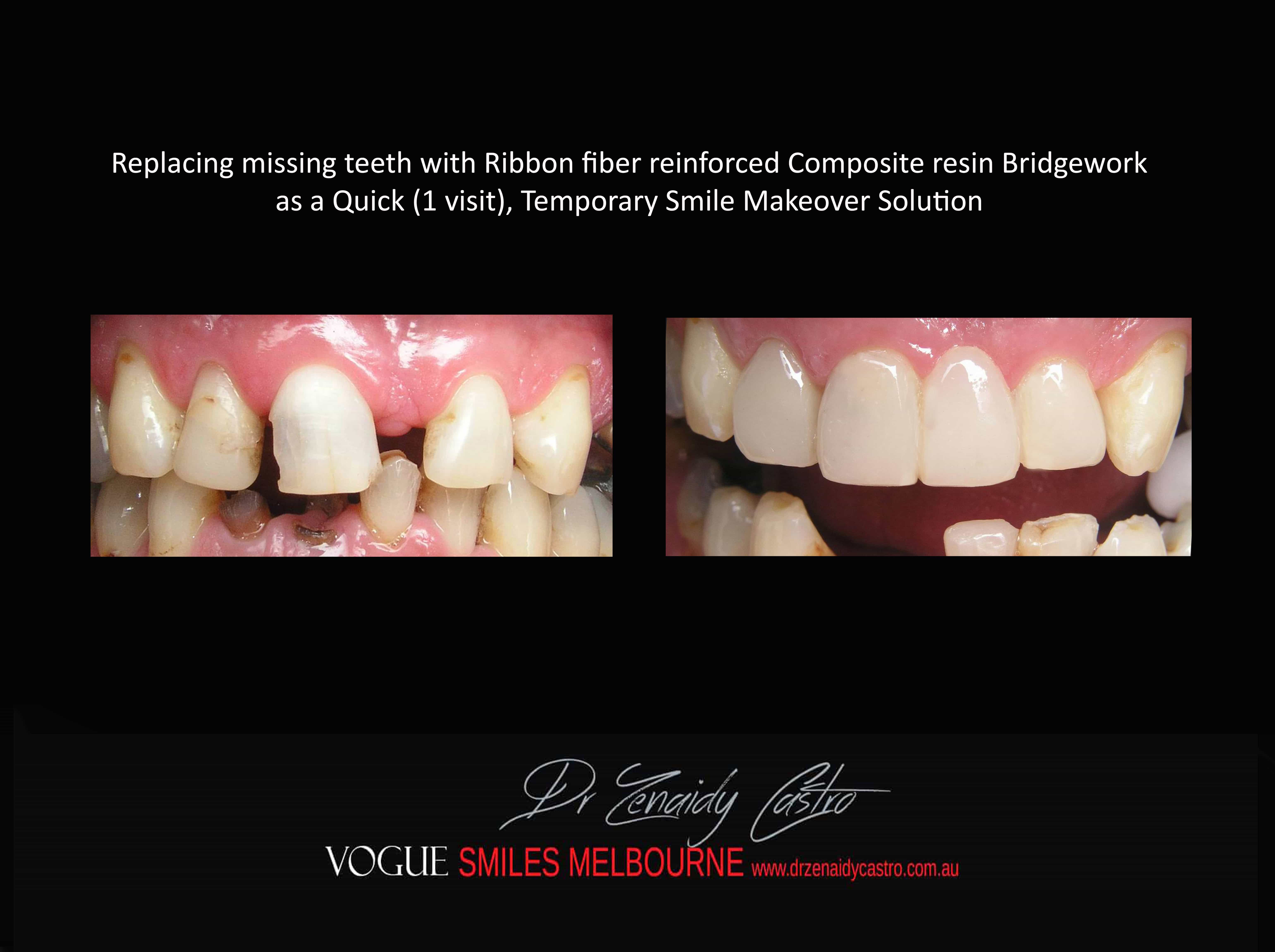 Replace Teeth Instantly - Affordable Same Day Smile Solution Melbourne -Intermediate smile Makeover Solution