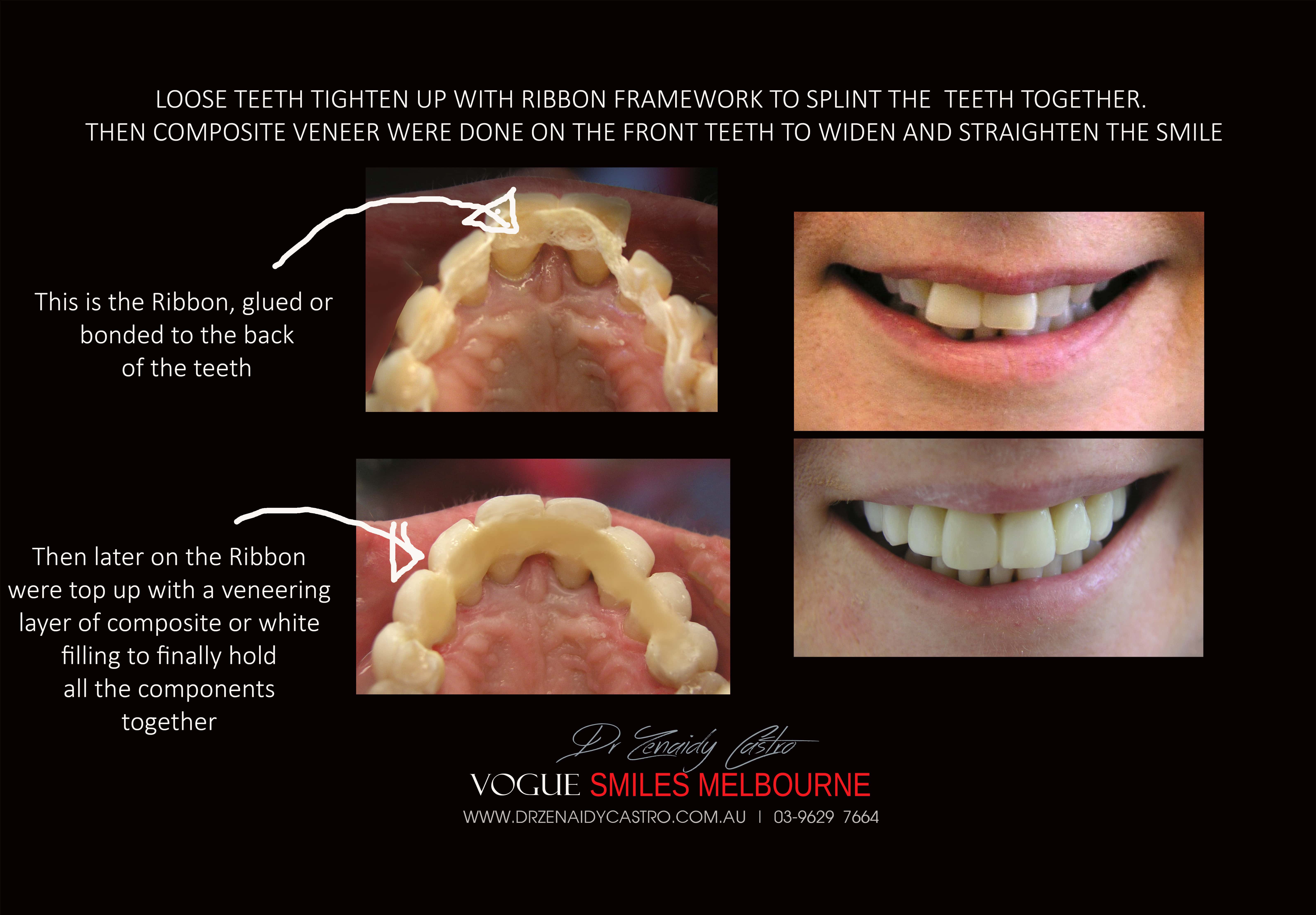 Replace Teeth Instantly - Affordable Same Day Smile Solution Melbourne -Intermediate smile Makeover Solution