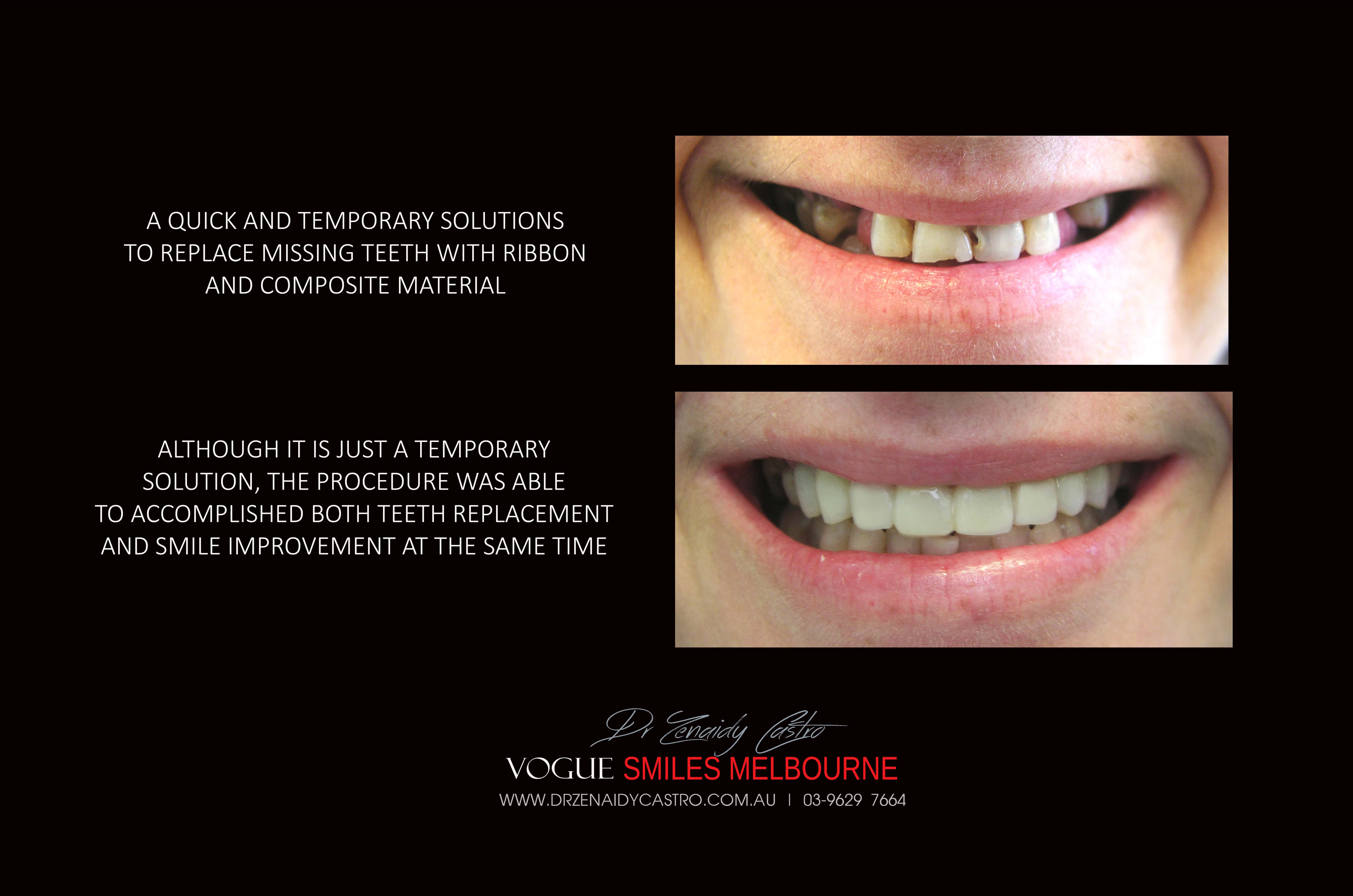 cheap, affordable, Low Cost Transitional Smile Makeover option Melbourne CBD
