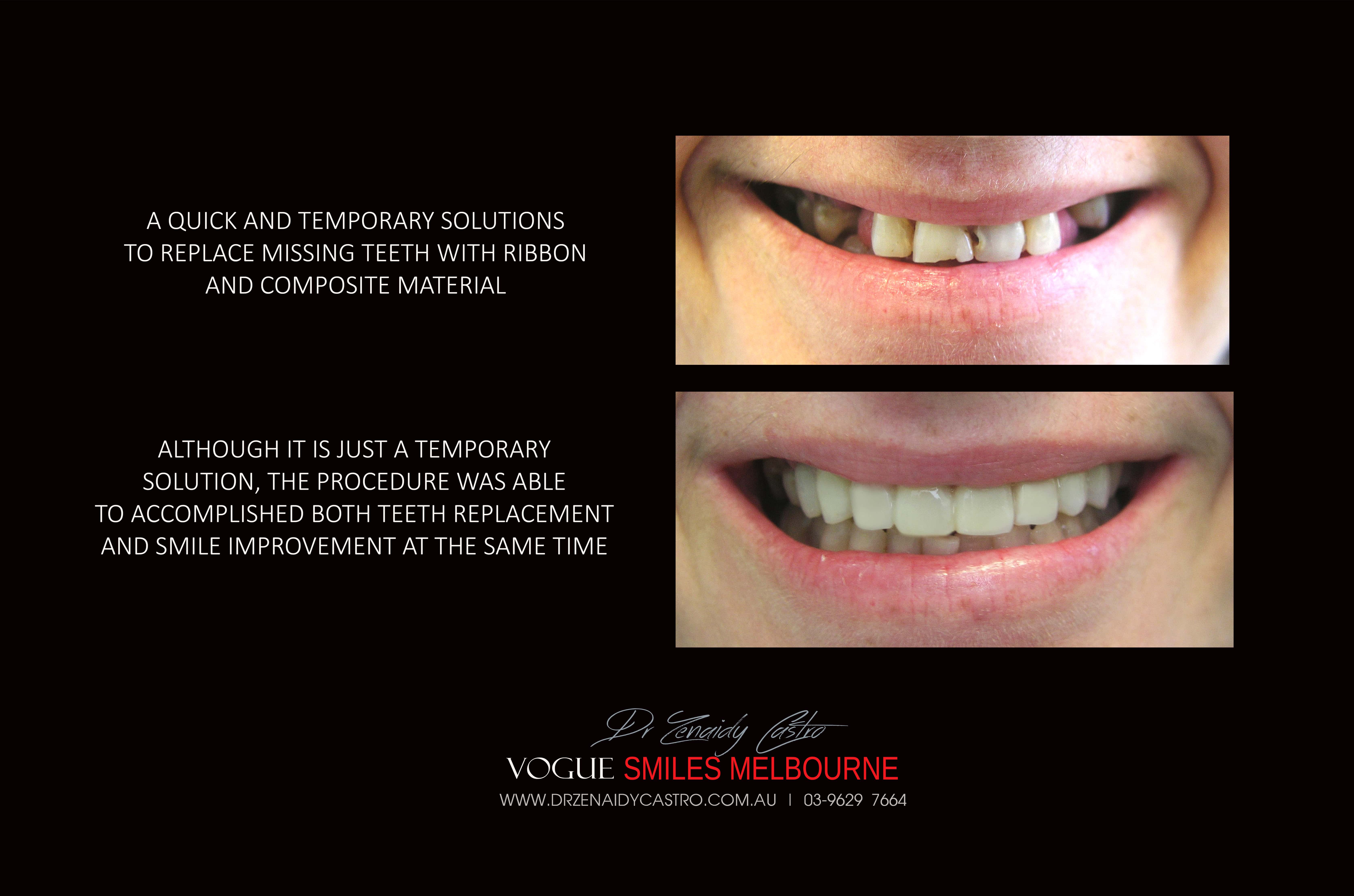 TRANSITIONAL SMILE MAKEOVER Melbourne CBD, Intermediate Cheapest most affordable Cosmetic Dentistry option to improve smile Melbourne Victoria Australia - Cosmetic Dentist Melbourne