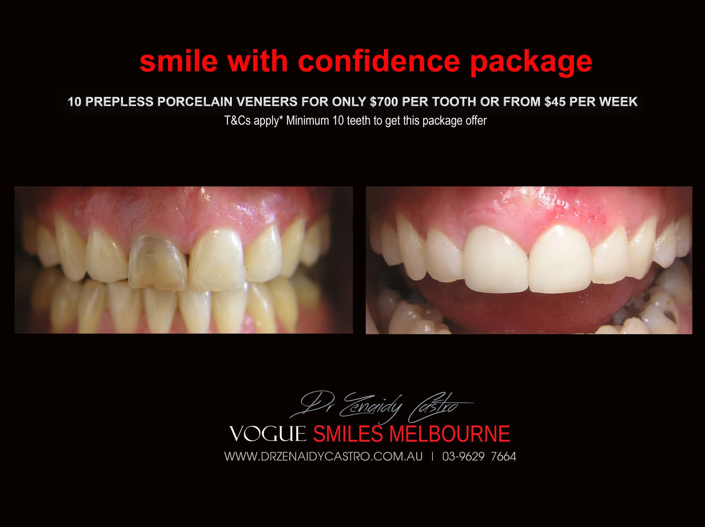 Black Tooth treatment- Dead Front tooth Treatment With Porcelain Veneers Melbourne CBD Cosmetic Dentist
