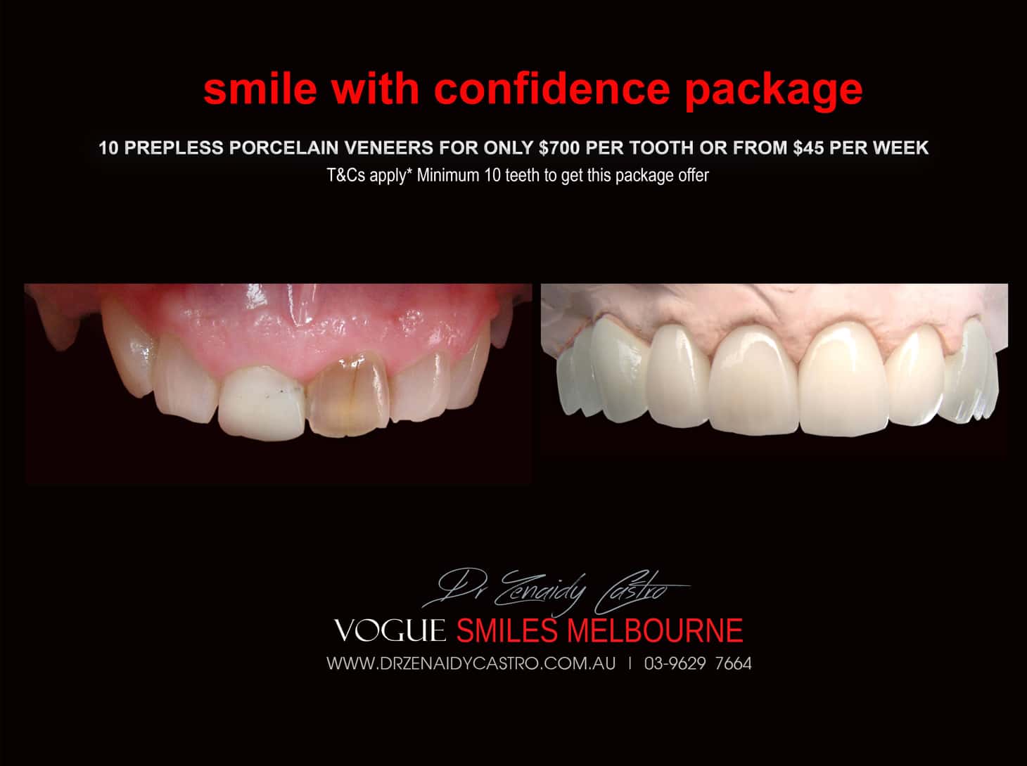 Black Tooth treatment- Dead Front tooth Treatment With Porcelain Veneers Melbourne CBD Cosmetic Dentist