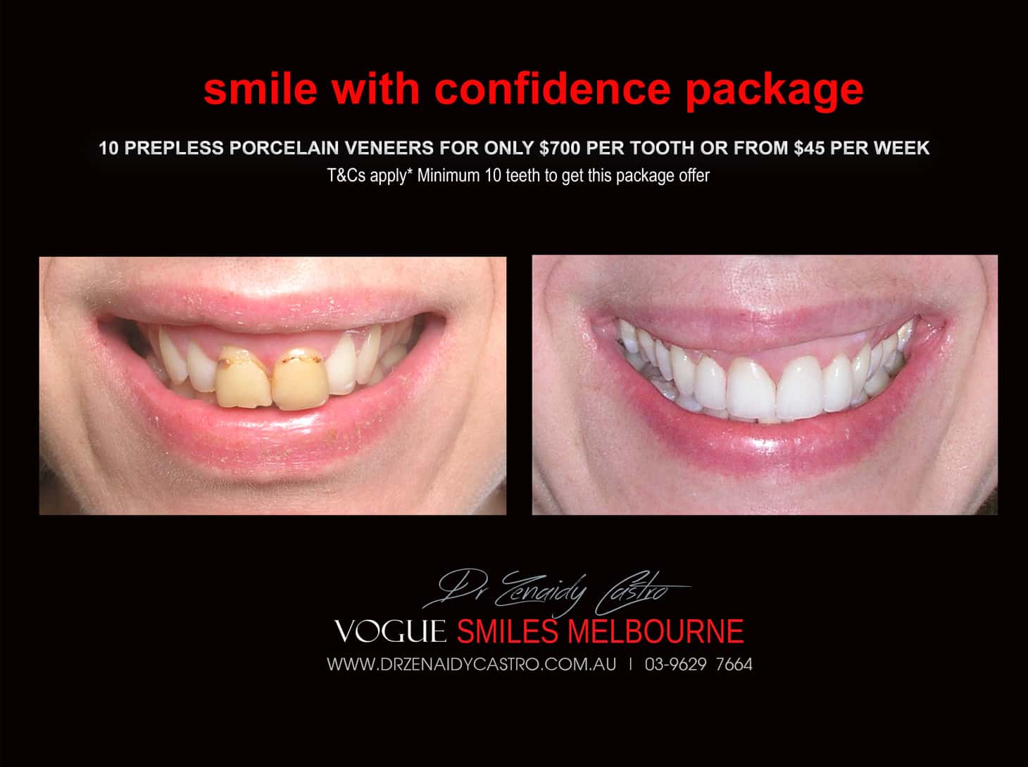 Black Tooth treatment- Dead Front tooth Treatment With Porcelain Veneers Melbourne CBD Cosmetic Dentist