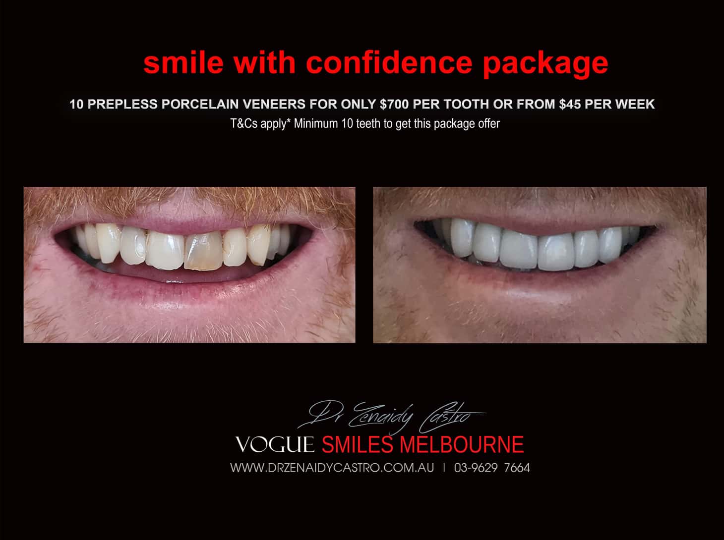 Porcelain Veneer Specials and Packages in Melbourne WITH PREPLESS / NO-PREP OR NO GRINDING -BEST DENTIST IN MELBOURNE - BEST COSMETIC DENTIST IN MELBOURNE CBD
