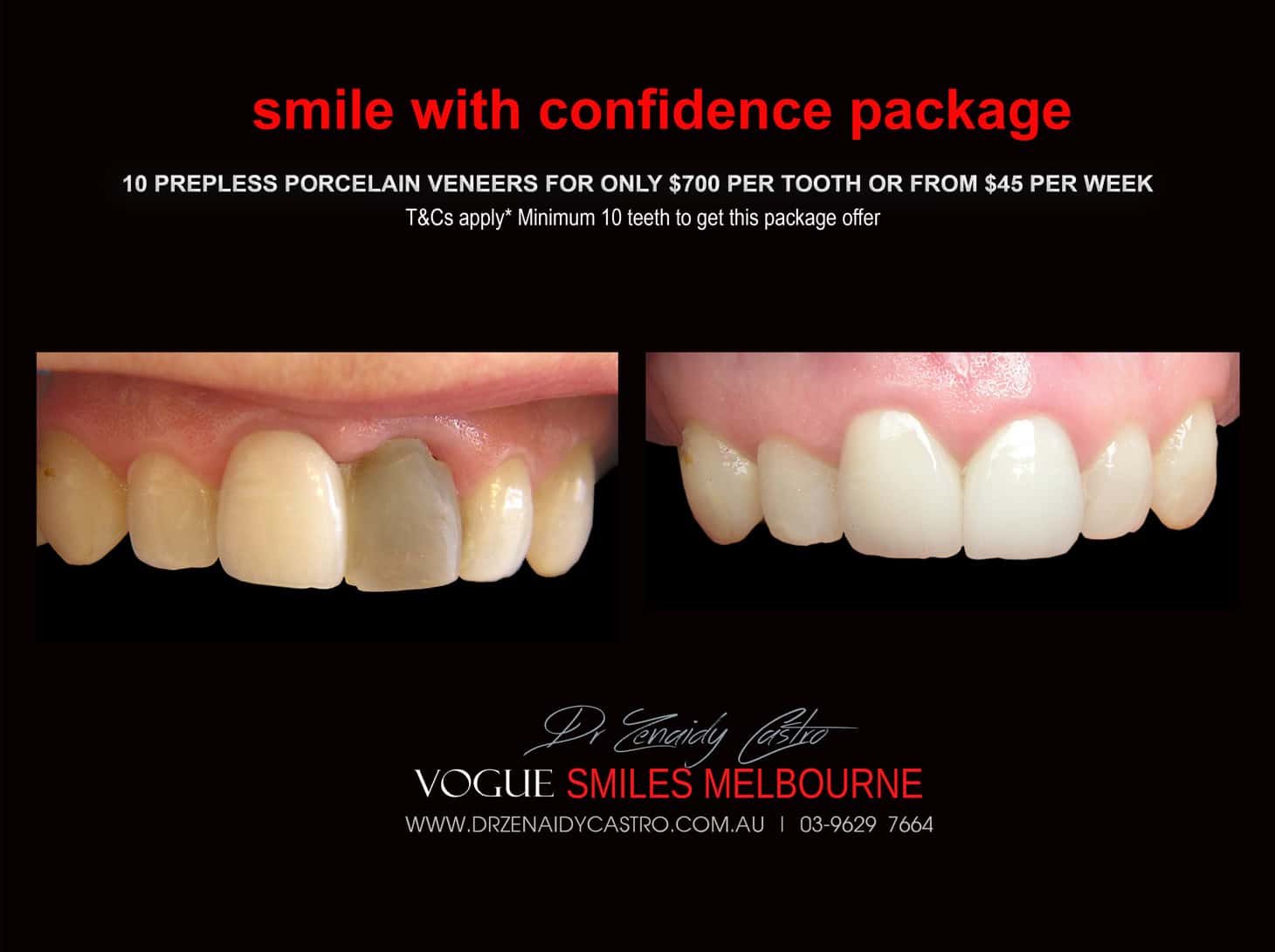 Composite Bonding resin veneers Melbourne CBD- Cosmetic Dentist Melbourne