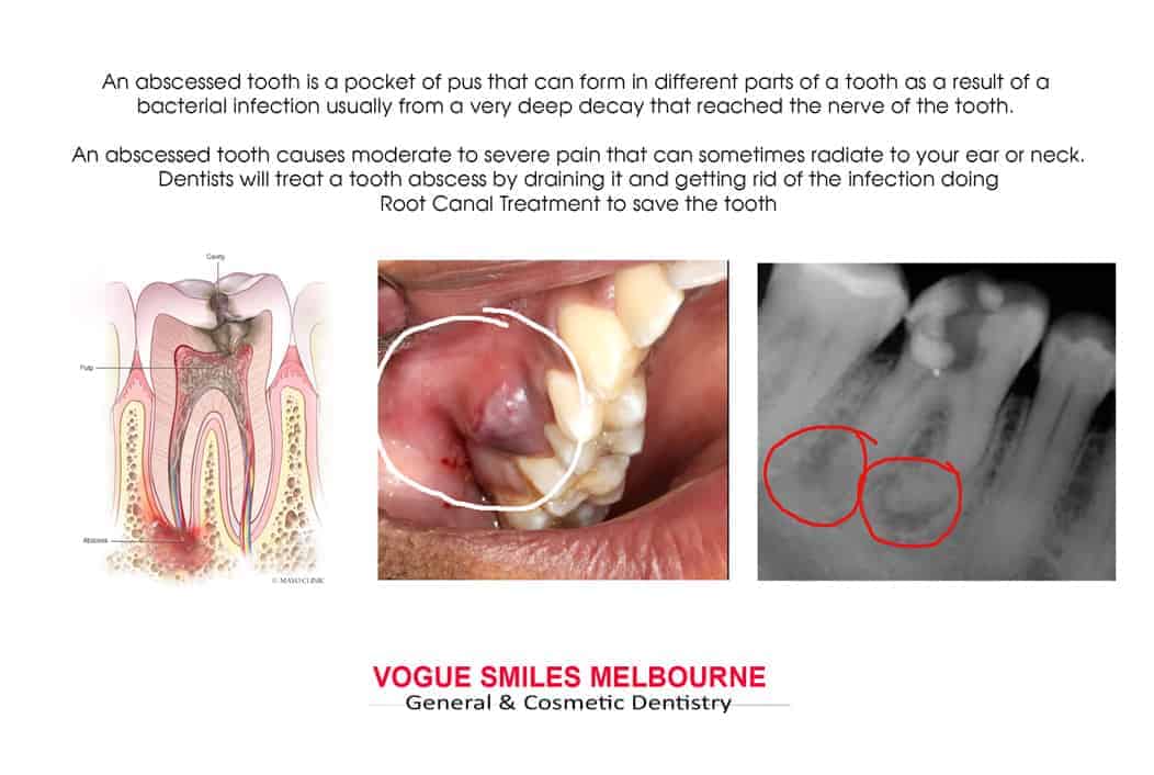 How do you treat an infected tooth abscess