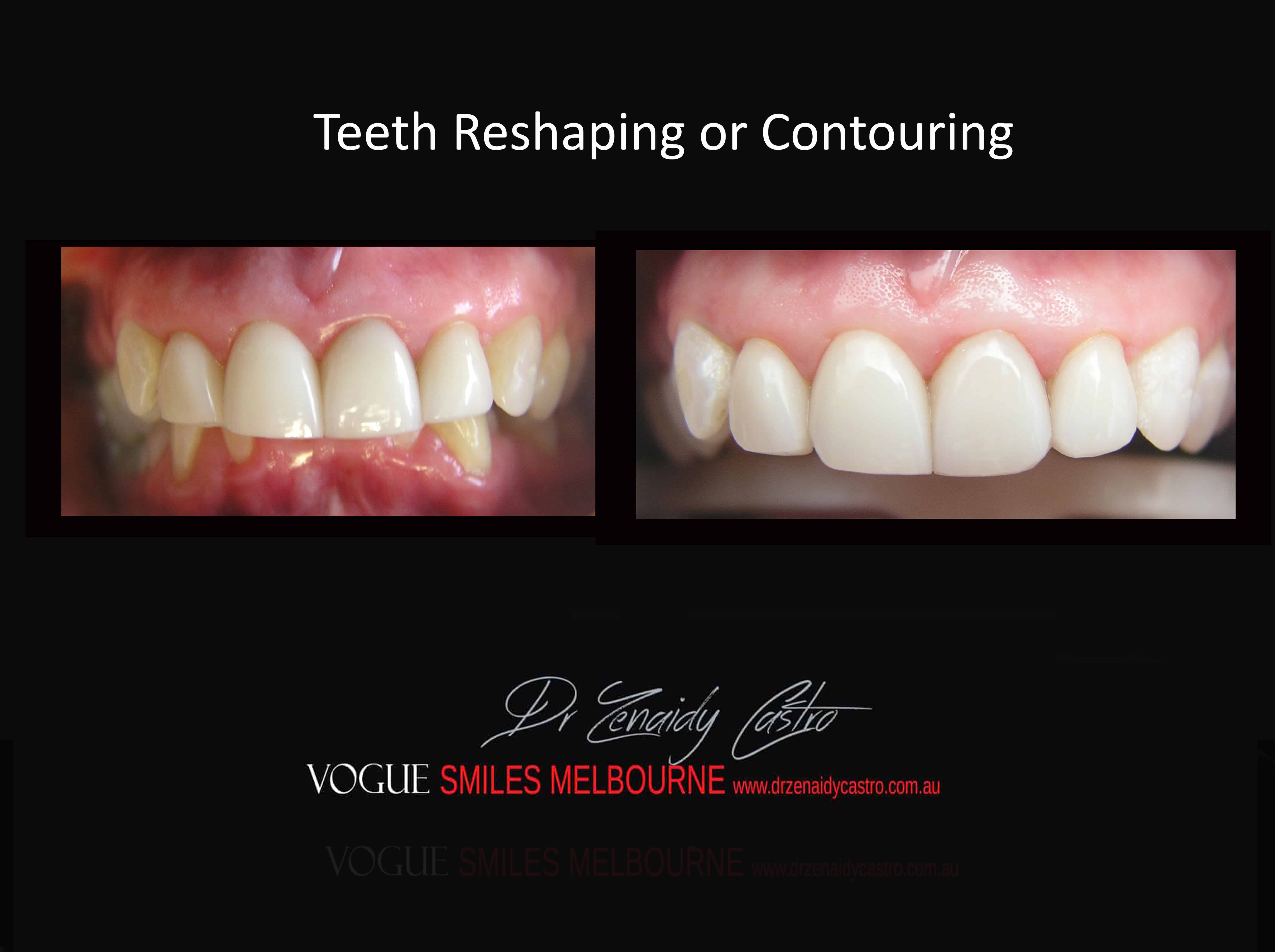 Cosmetic Tooth Contouring or Tooth Reshaping, Tooth Reshaping in Melbourne, Tooth Recontouring by Dentists Melbourne, Teeth Reshaping And Gum Contouring Melbourne