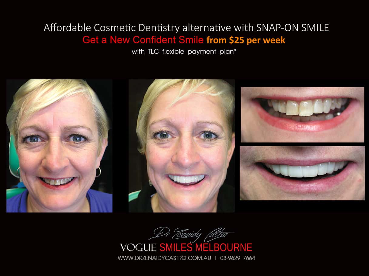 Smile Rejuvenation by Vogue Smiles Melbourne, rejuvenation clinic Melbourne, Non-surgical Facial Rejuvenation Melbourne, Anti Aging Treatment Melbourne