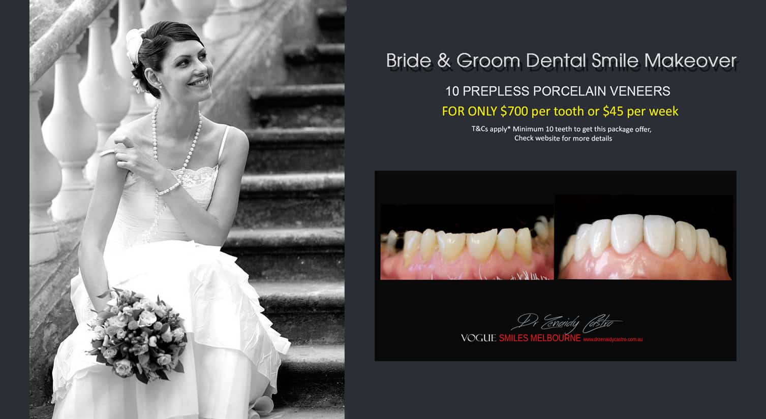 Wedding Smile Makeover Specials and Packages in Melbourne | Cosmetic Dentistry Bride and Groom BRIDAL wedding package deals | cheap wedding packages Melbourne