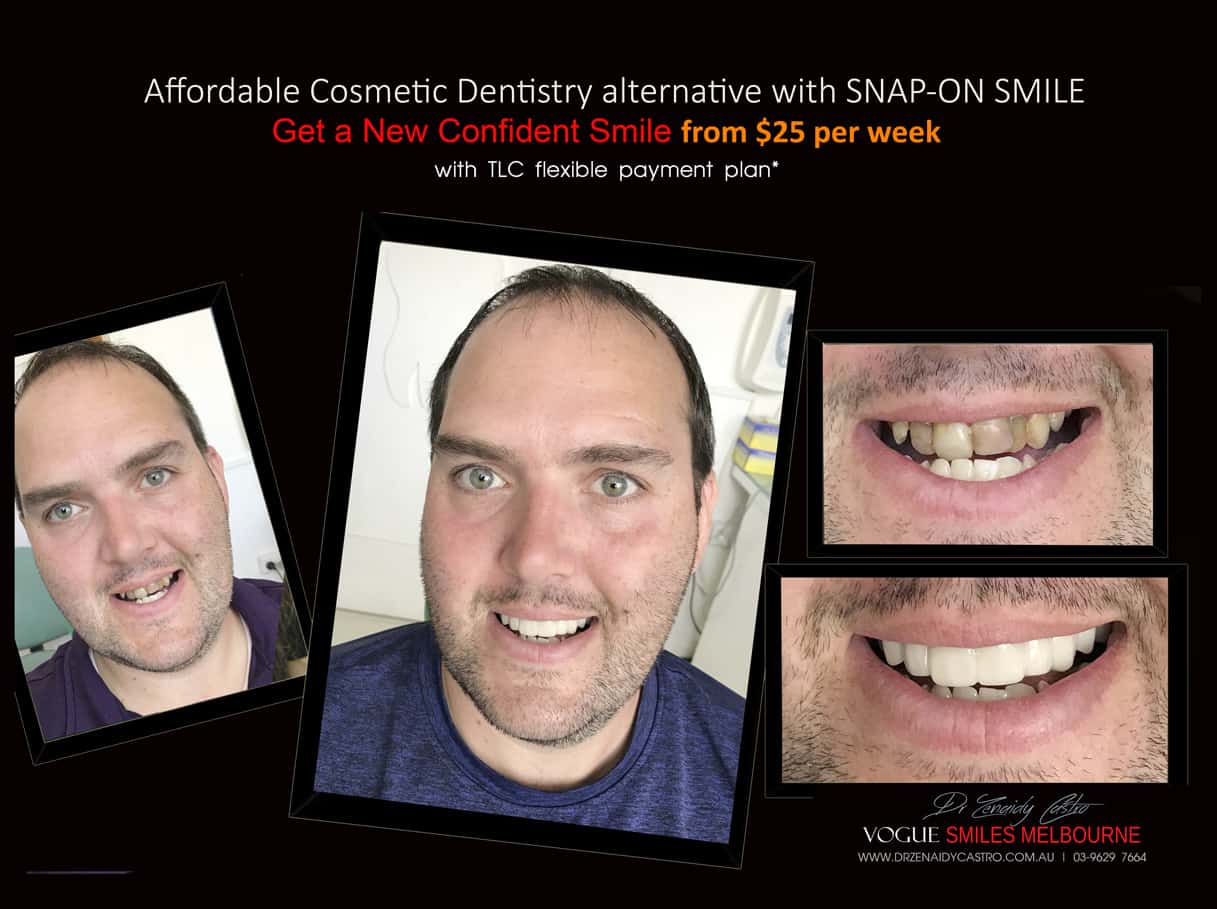 Most Affordable Way To Improve Your Smile Melbourne- CHEAPEST COSMETIC DENTISTRY SMILE MAKEOVER OPTION MELBOURNE DENTIST -Affordable Ways to Fix Your Smile and Boost Your Confidence