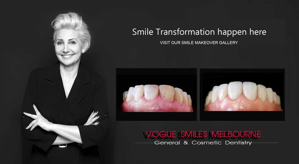 Smile Makeover Procedures Melbourne CBD Victoria Australia - Best Dentist Melbourne - Dr Zenaidy Castro - VOGUE SMILES MELBOURNE
