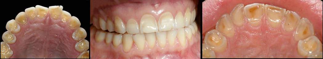 BULIMIA EATING DISORDER ACID EROSION ON TEETH dentist melbourne