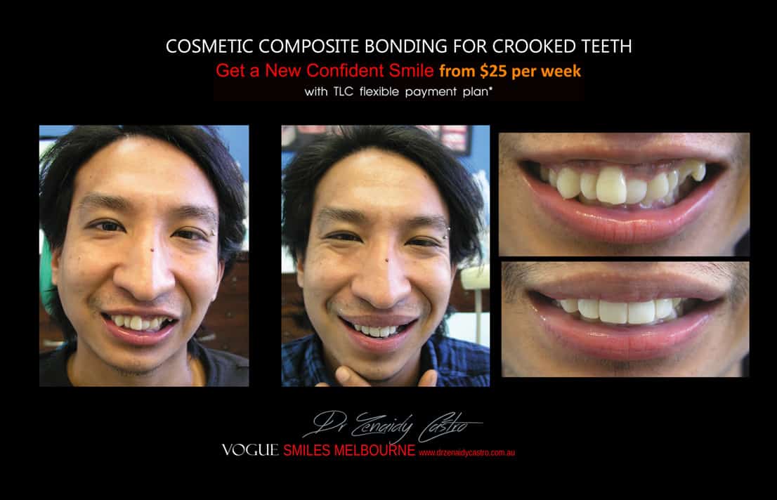 Cosmetic Bonding for Crooked Teeth Melbourne CBD Cosmetic Dentist