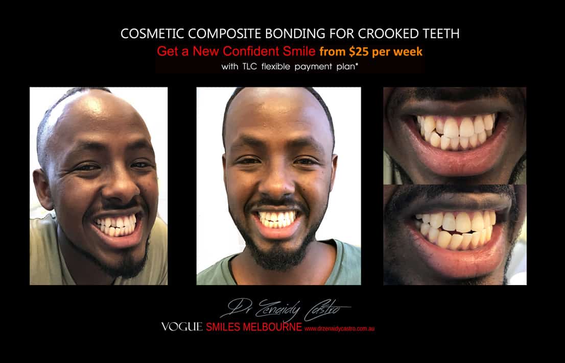 Cosmetic Bonding for Crooked Teeth Melbourne CBD Cosmetic Dentist