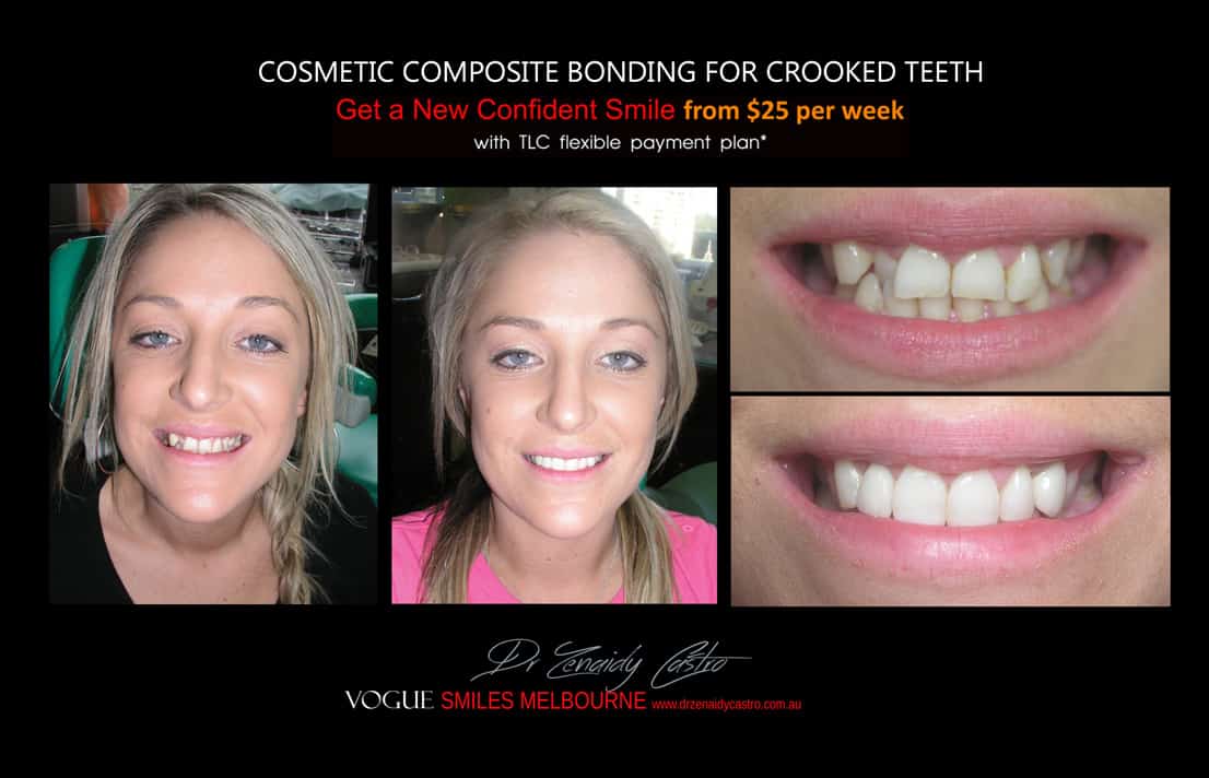 Cosmetic Bonding for Crooked Teeth Melbourne CBD Cosmetic Dentist