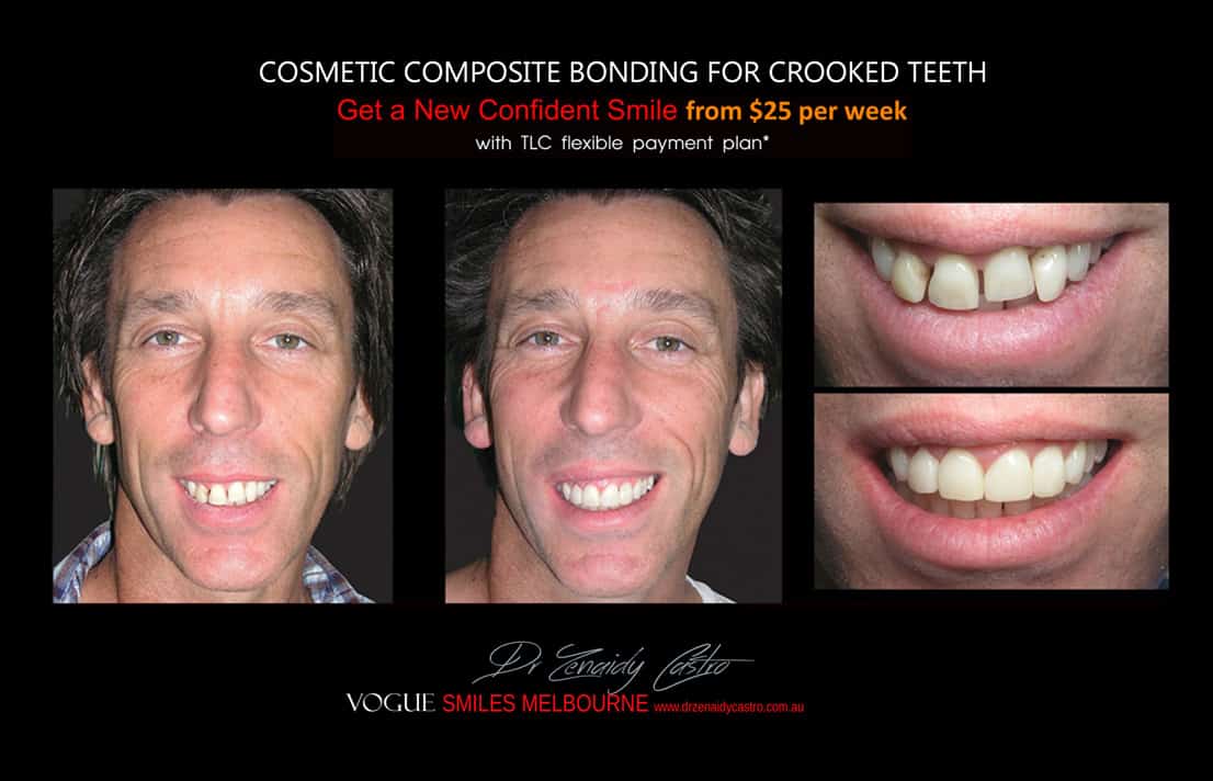 Cosmetic Bonding for Crooked Teeth Melbourne CBD Cosmetic Dentist