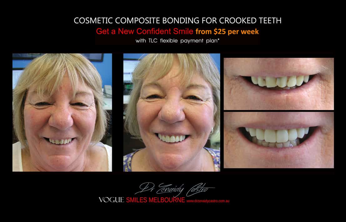 Cosmetic Bonding for Crooked Teeth Melbourne CBD Cosmetic Dentist