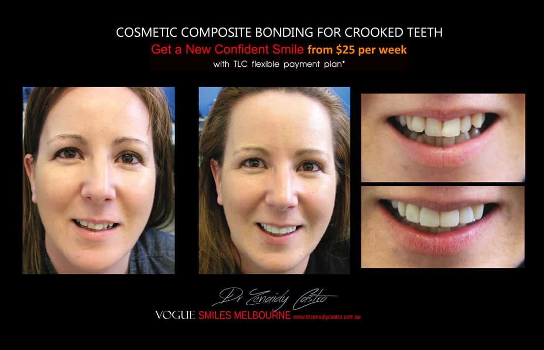 Cosmetic Bonding for Crooked Teeth Melbourne CBD Cosmetic Dentist