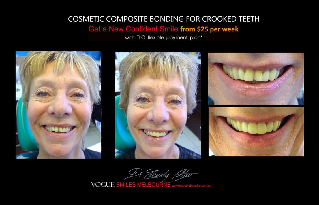 Cosmetic Bonding for Crooked Teeth Melbourne CBD Cosmetic Dentist