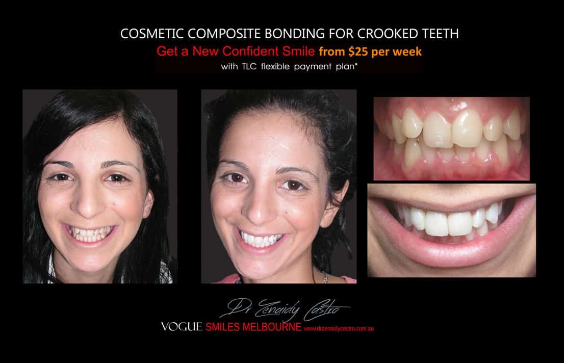 Cosmetic Bonding for Crooked Teeth Melbourne CBD Cosmetic Dentist