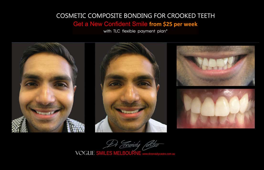 Cosmetic Bonding for Crooked Teeth Melbourne CBD Cosmetic Dentist