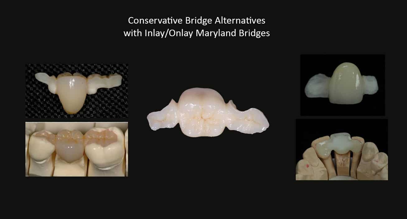 Conservative Bridge Alternatives with Inlay/Onlay Maryland Bridges