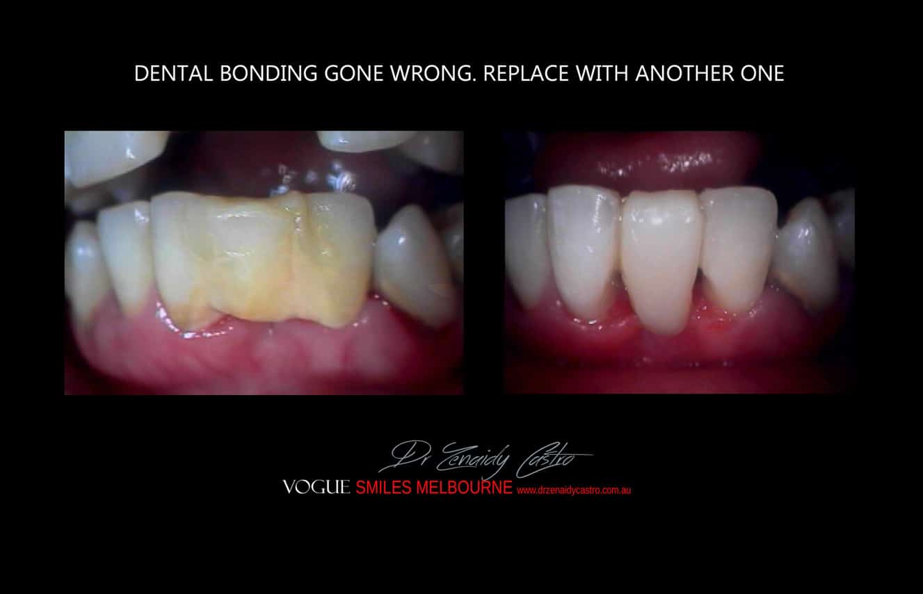 Composite Bonding resin veneers Melbourne CBD- Cosmetic Dentist Melbourne