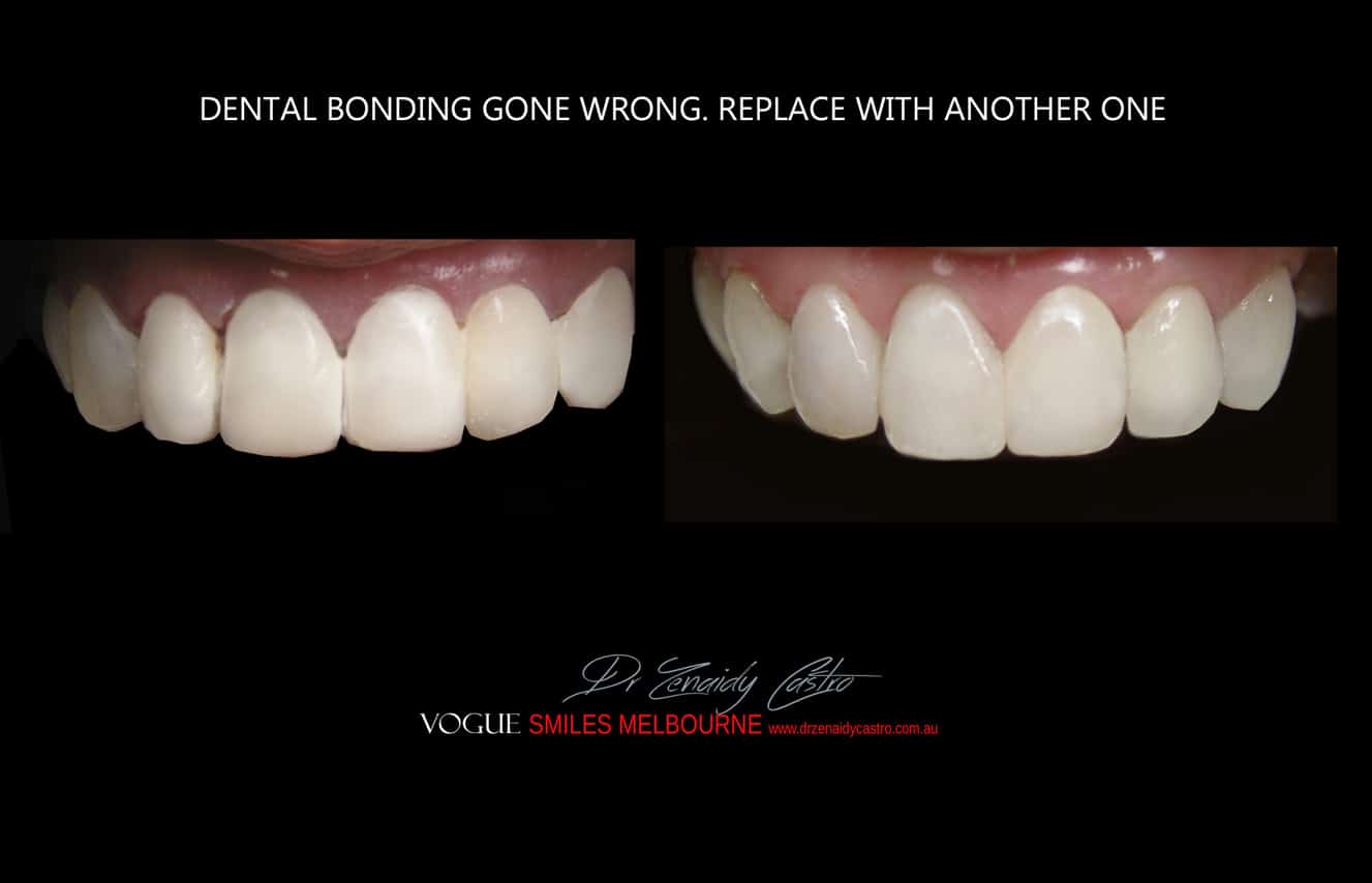 Composite Bonding resin veneers Melbourne CBD- Cosmetic Dentist Melbourne