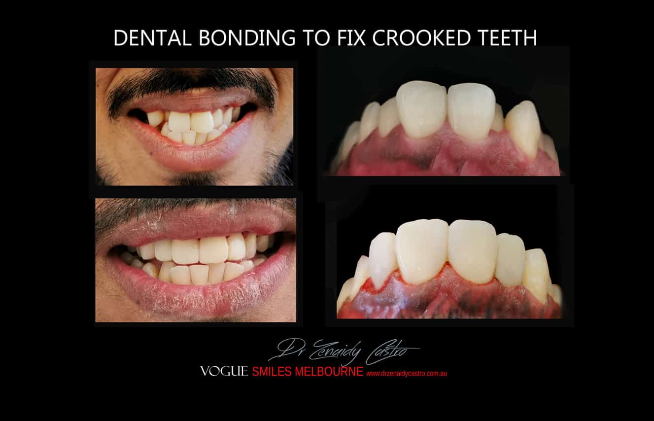 Composite Veneers Vs. Porcelain Veneers Melbourne CBD - Cosmetic Bonding versus Ceramic dental Veneers Melbourne