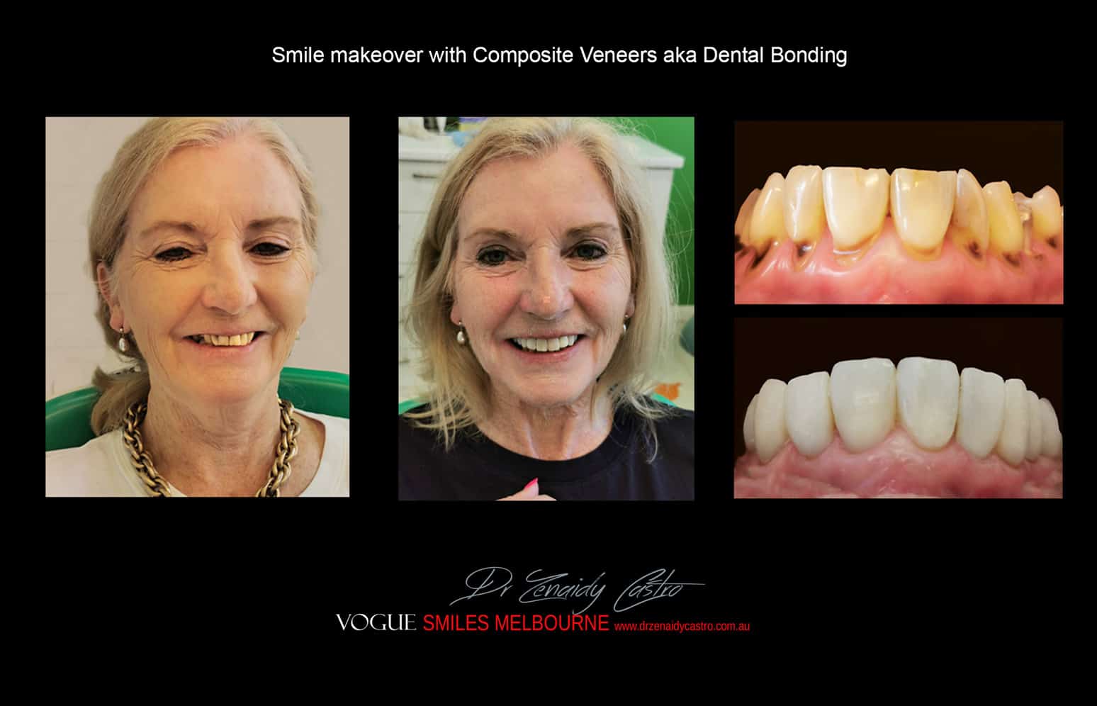 Composite Veneers Vs. Porcelain Veneers Melbourne CBD - Cosmetic Bonding versus Ceramic dental Veneers Melbourne