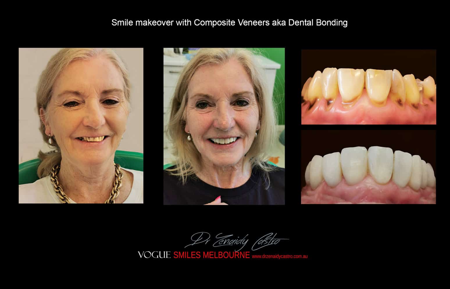 Dental Bonding Melbourne CBD, Composite Resin Bonding Melbourne City CBD , Composite Veneers Melbourne CBD -Composite Dental Bonding - Affordable Smile Makeover Procedure Affordable Cosmetic Dentist Melbourne CBD