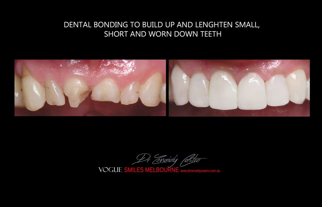 Composite Veneers Melbourne CBD, Composite Resin Bonding Melbourne CBD, Composite Bonding, Same day smile Melbourne CBD