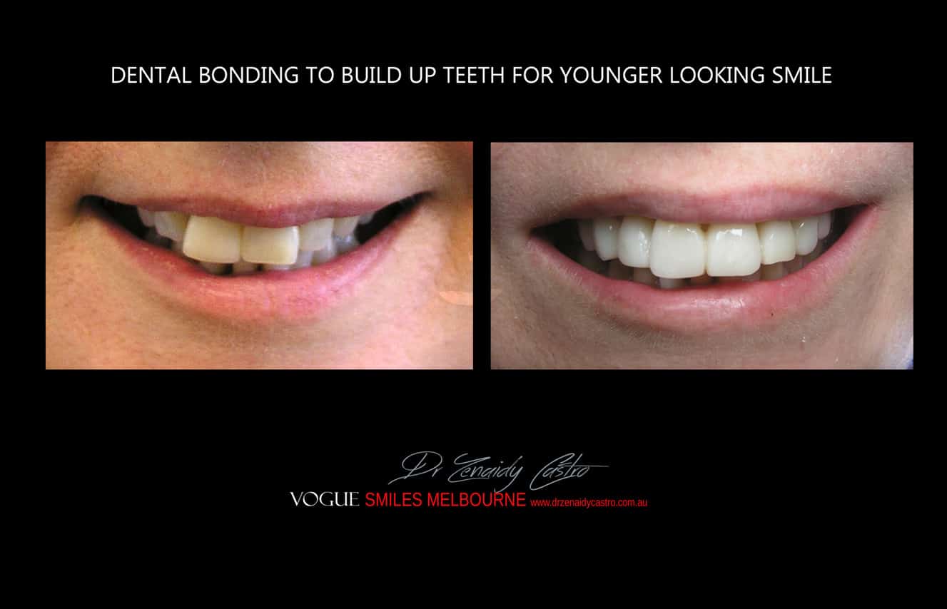 Composite Bonding resin veneers Melbourne CBD- Cosmetic Dentist Melbourne