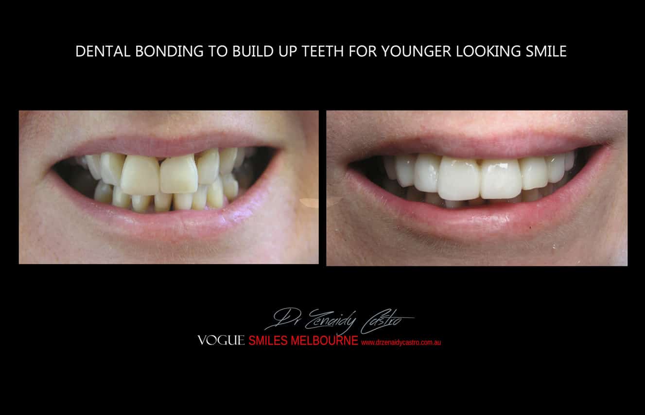 Composite Veneers Melbourne CBD, Composite Resin Bonding Melbourne CBD, Composite Bonding, Same day smile Melbourne CBD